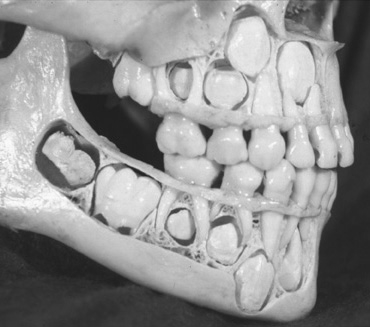 child-skull1