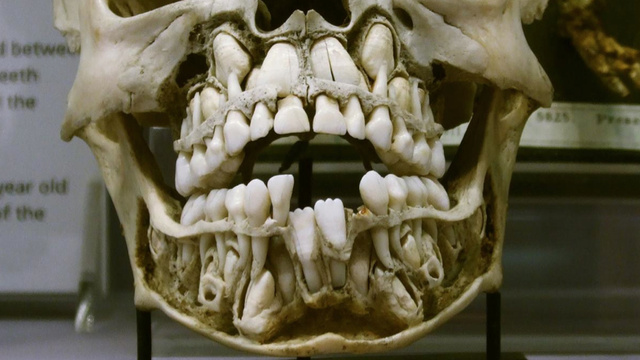 child-skull2